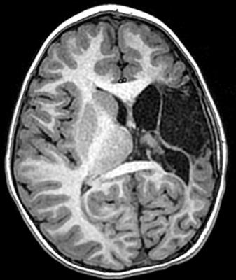 Examining the Utility of Resective Epilepsy Surgery in Children With Electrical Status Epilepticus in Sleep: Long Term Clinical and Electrophysiological Outcomes